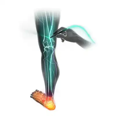 Illustration of a Stimpod therapy probe applied in the leg